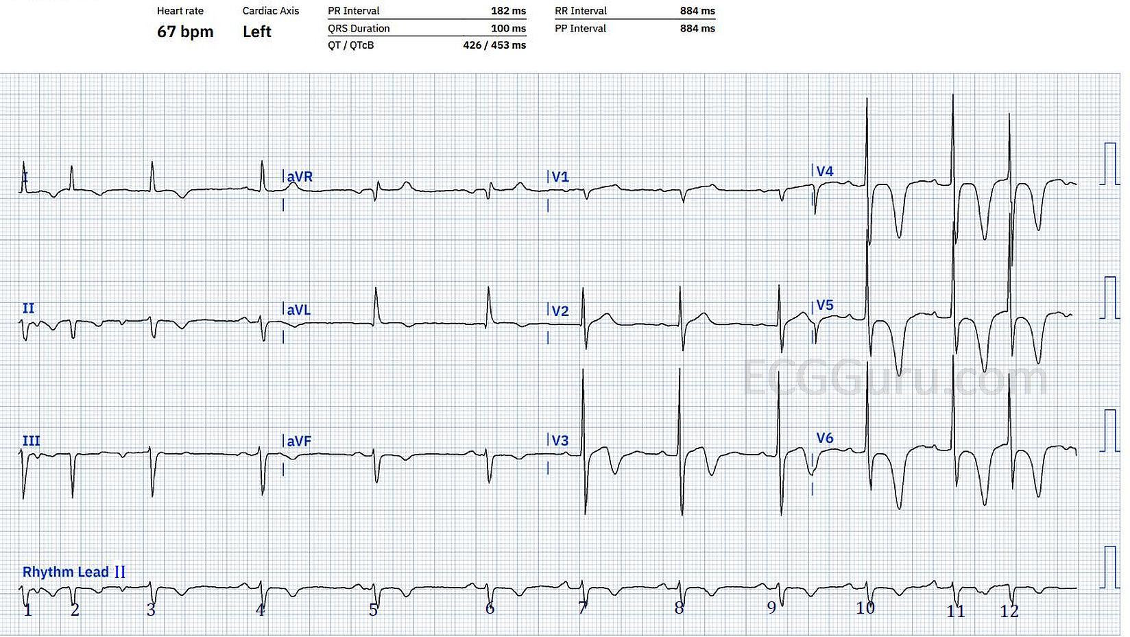 Sinus rhythm t wave inversion online vivatumusica